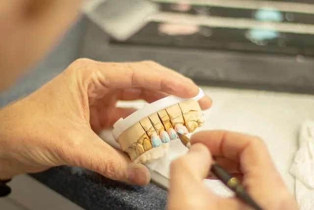 Dental Implants